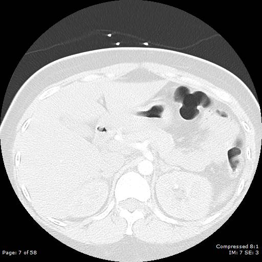 Bilateral pulmonary emboli with Hampton hump sign (Radiopaedia 54070-60246 Axial lung window 7).jpg