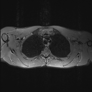 File:Bilateral spinoglenoid notch ganglion cysts (Radiopaedia 29577-30082 Axial STIR 23).jpg