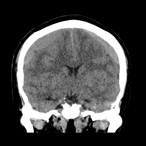 Bilateral subacute subdural hematoma (Radiopaedia 69240-79018 Coronal non-contrast 27).jpg