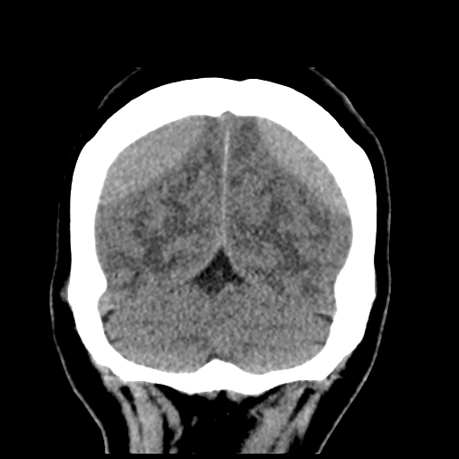 Bilateral subacute subdural hematoma (Radiopaedia 69240-79018 Coronal non-contrast 48).jpg