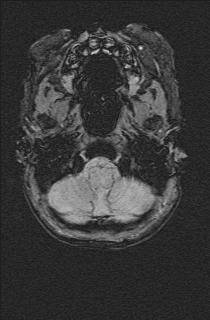 Bilateral subdural hemorrhage and parietal skull fracture (Radiopaedia 26058-26190 Axial SWI 6).png