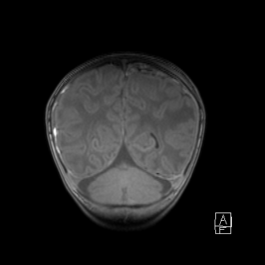 Bilateral subdural hemorrhage and parietal skull fracture (Radiopaedia 26058-26190 Coronal T1 42).png