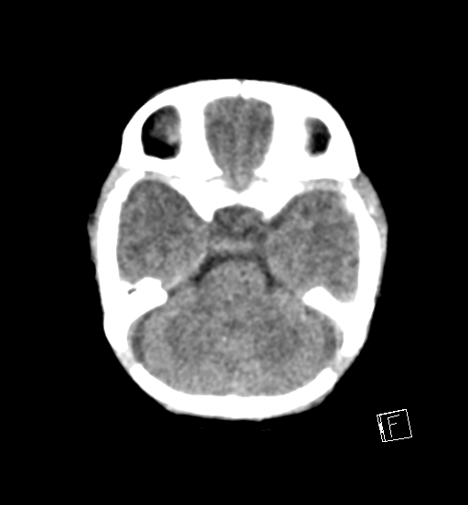 File:Bilateral subdural hemorrhage and parietal skull fracture (Radiopaedia 26058-26192 Axial non-contrast 19).png