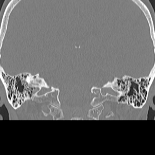 File:Bilateral tympanoplasty (Radiopaedia 16947-16664 Coronal bone window 23).jpg