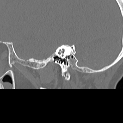 Bilateral tympanoplasty (Radiopaedia 16947-16664 Sagittal bone window 39).jpg