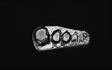 Bipartite hallux sesamoid diastasis (Radiopaedia 77133-89109 Coronal PD 31).jpg