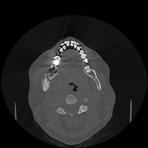 File:Bisphosphonate-related osteonecrosis of the jaw (Radiopaedia 71324-81642 Axial bone window 71).jpg
