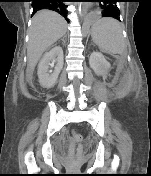 Bladder rupture post renal biopsy (Radiopaedia 30863-31572 Coronal non-contrast 41).jpg