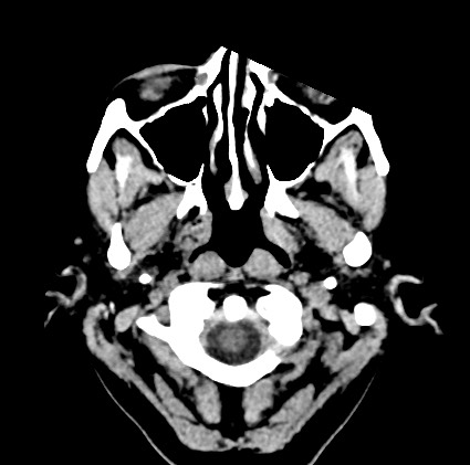 File:Blood on the tentorium simulating hyperdense transverse sinus (Radiopaedia 55521-61991 Axial non-contrast 1).jpg