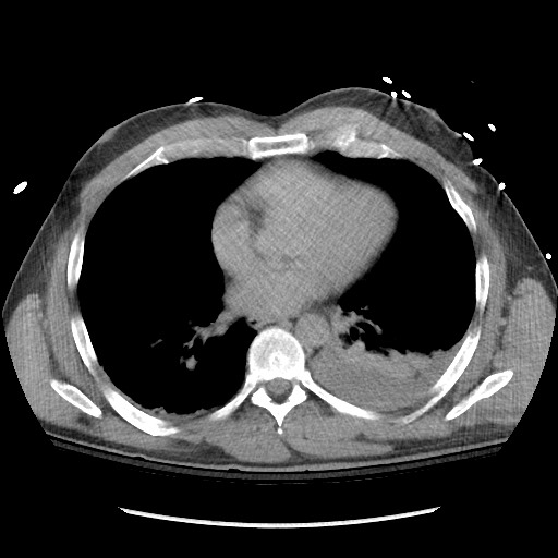 Blunt abdominal trauma with solid organ and musculoskelatal injury with active extravasation (Radiopaedia 68364-77895 Axial C+ delayed 2).jpg