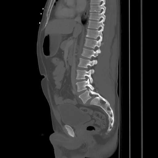 Blunt abdominal trauma with solid organ and musculoskelatal injury with active extravasation (Radiopaedia 68364-77895 Sagittal bone window 47).jpg