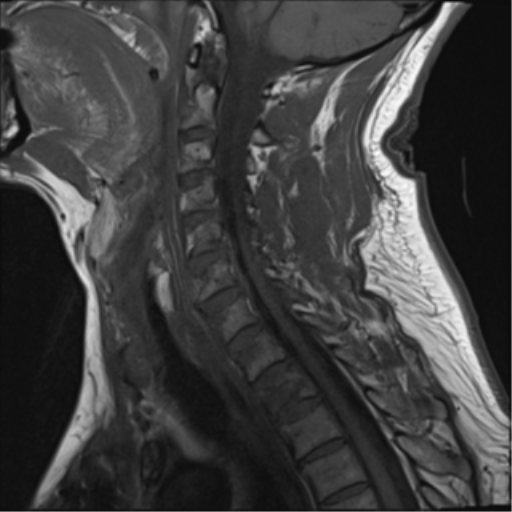File:Blunt cerebrovascular injury (Radiopaedia 53682-59744 Sagittal T1 6).png