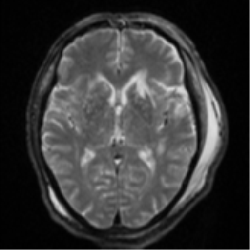 Blunt cerebrovascular injury (Radiopaedia 53682-59745 Axial DWI 16).png