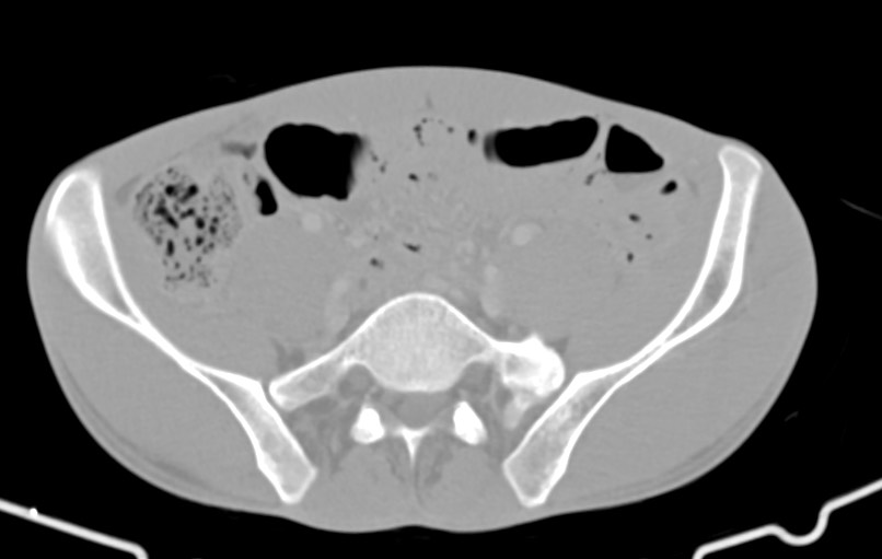Blunt injury to the small bowel (Radiopaedia 74953-85987 Axial Wide 70).jpg