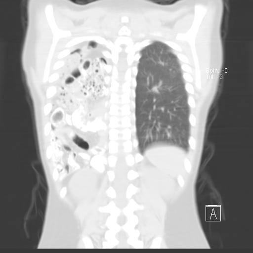File:Bochdalek diaphragmatic hernia (Radiopaedia 38866-41059 Coronal lung window 17).jpg