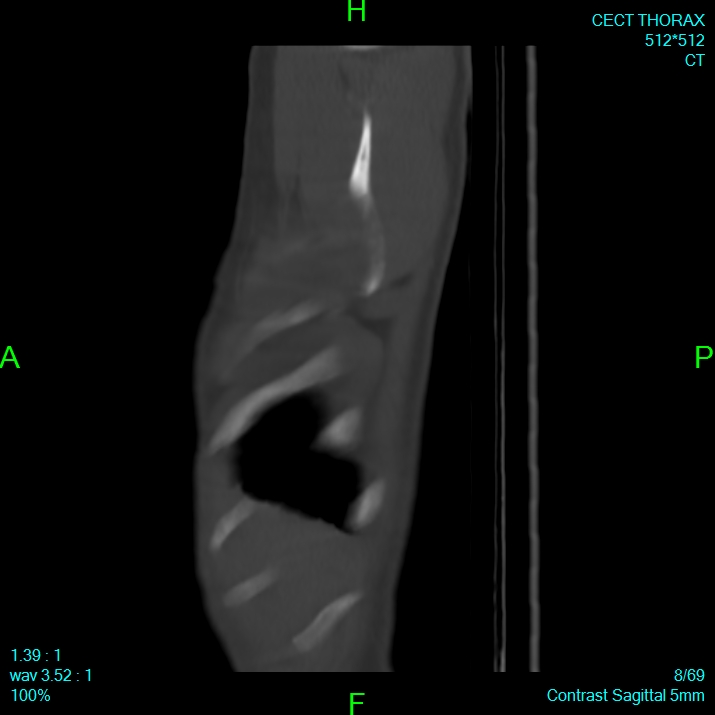 Bone metastases from lung carcinoma (Radiopaedia 54703-60937 Sagittal bone window 8).jpg