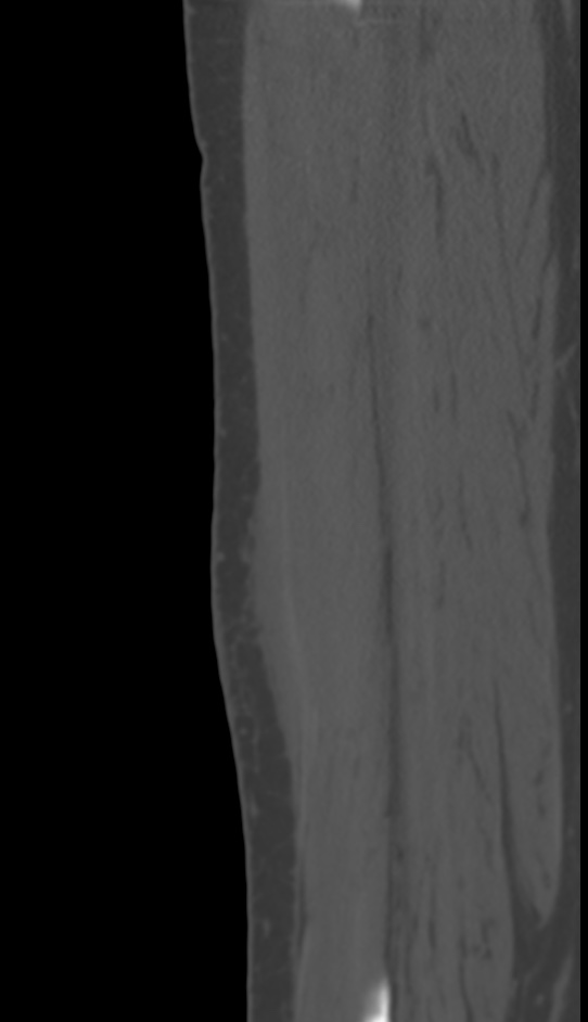 Bone metastasis - tibia (Radiopaedia 57665-64609 Sagittal bone window 127).jpg