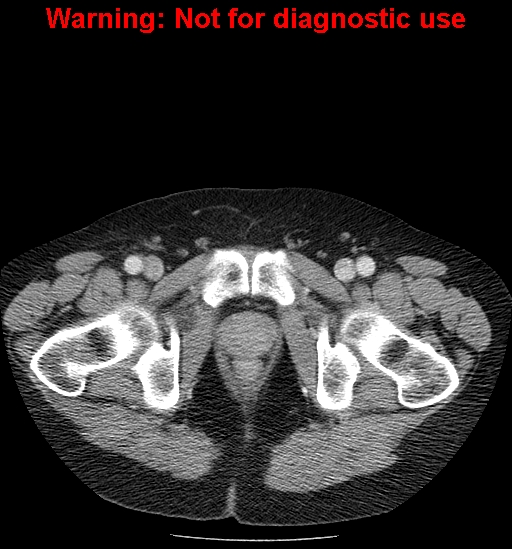 File:Bosniak renal cyst - type IV (Radiopaedia 23402-23466 D 82).jpg