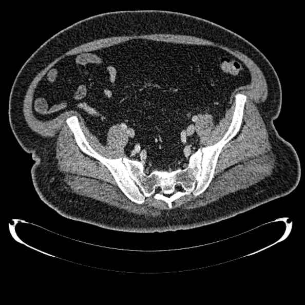 Bosniak renal cyst - type IV (Radiopaedia 24244-24518 C 313).jpg