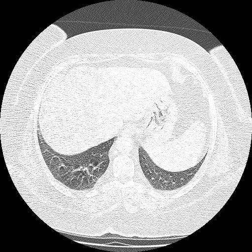 Bovine aortic arch - right internal mammary vein drains into the superior vena cava (Radiopaedia 63296-71875 Axial lung window 141).jpg