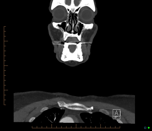 Brachiocephalic trunk stenosis (Radiopaedia 87242-103519 B 7).jpg