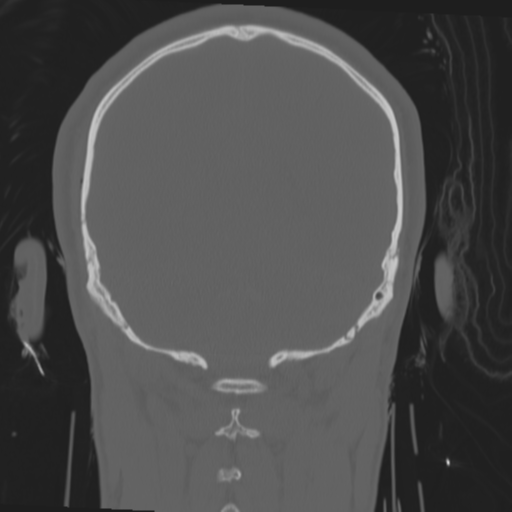 File:Brain contusions, internal carotid artery dissection and base of skull fracture (Radiopaedia 34089-35339 Coronal bone window 51).png