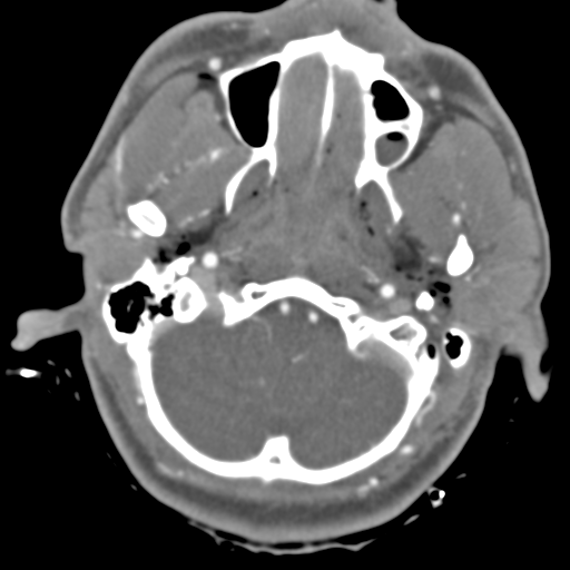 File:Brain contusions, internal carotid artery dissection and base of skull fracture (Radiopaedia 34089-35339 D 48).png