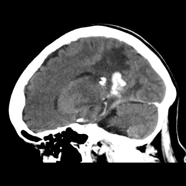 File:Brain metastases from breast cancer (Radiopaedia 23178-23231 C 20).jpg
