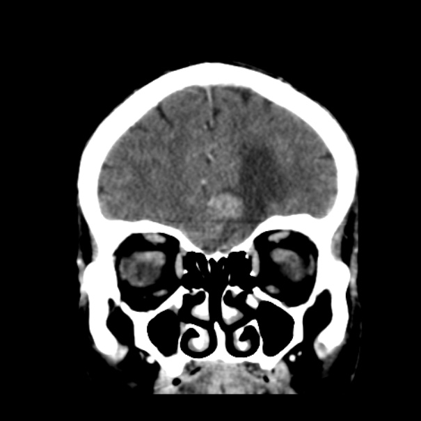 Brain metastases from lung cancer (Radiopaedia 24480-24781 Coronal C+ delayed 14).jpg