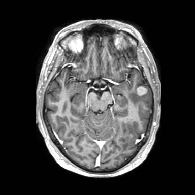 File:Brain metastases from lung cancer (Radiopaedia 83839-99028 Axial T1 C+ 23).jpg