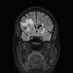 Brain metastases from lung cancer (Radiopaedia 83839-99028 Coronal FLAIR 24).jpg