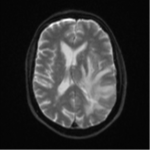 File:Brain metastasis (large cystic mass) (Radiopaedia 47497-52107 Axial DWI 16).png