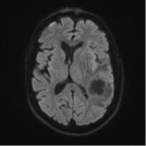 File:Brain metastasis (large cystic mass) (Radiopaedia 47497-52107 Axial DWI 43).png