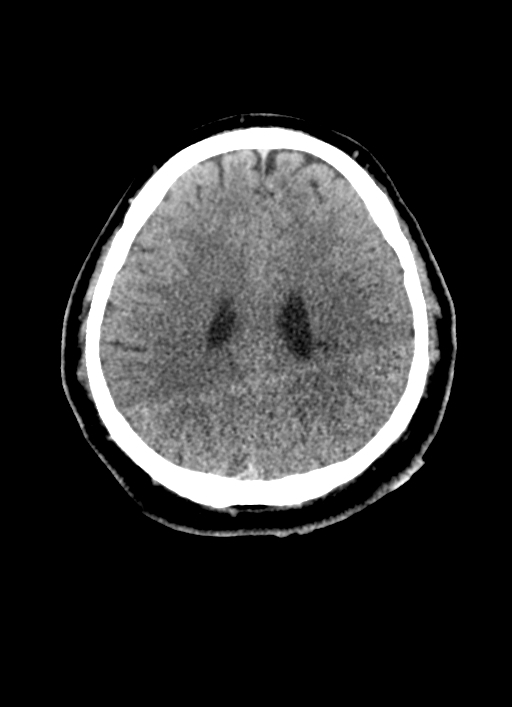 Brainstem hemorrhage (Radiopaedia 81294-94976 Axial non-contrast 23).jpg