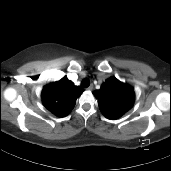 File:Breast metastases from renal cell cancer (Radiopaedia 79220-92225 A 16).jpg