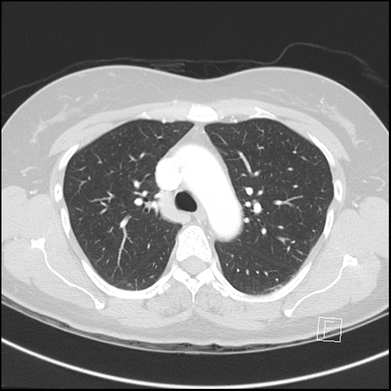 File:Breast metastases from renal cell cancer (Radiopaedia 79220-92225 Axial lung window 27).jpg