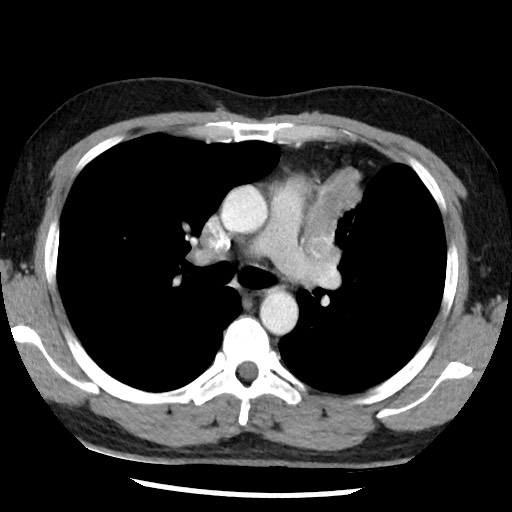 Bronchial carcinoid tumor (Radiopaedia 67377-76764 A 27).jpg