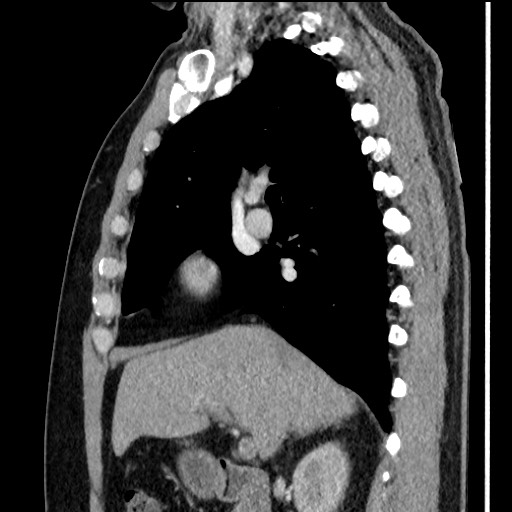 Bronchial carcinoid tumor (Radiopaedia 67377-76764 E 28).jpg