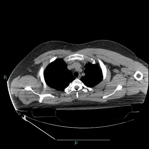 Bronchial carcinoid tumor (Radiopaedia 78272-90870 Axial non-contrast 22).jpg