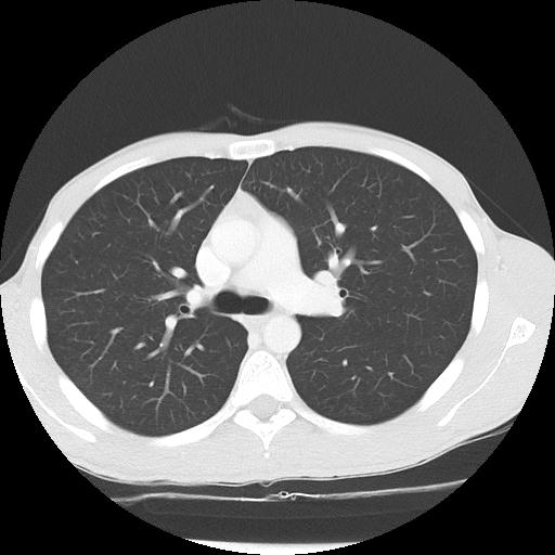 Bronchial carcinoid tumor causing right lower lobe collapse (Radiopaedia 83495-98594 Axial lung window 19).jpg