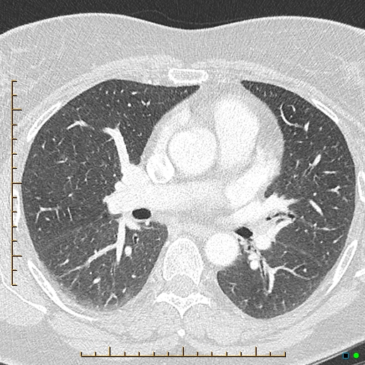 Bronchial diverticula (Radiopaedia 79512-92676 Axial lung window 92).jpg