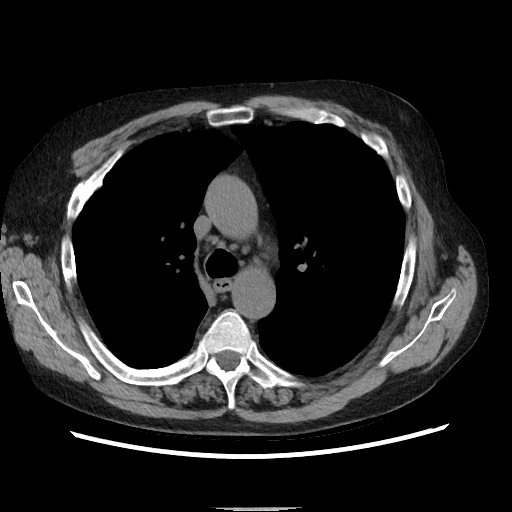 File:Bronchial stenosis - lung transplant (Radiopaedia 73133-83848 Axial non-contrast 24).jpg
