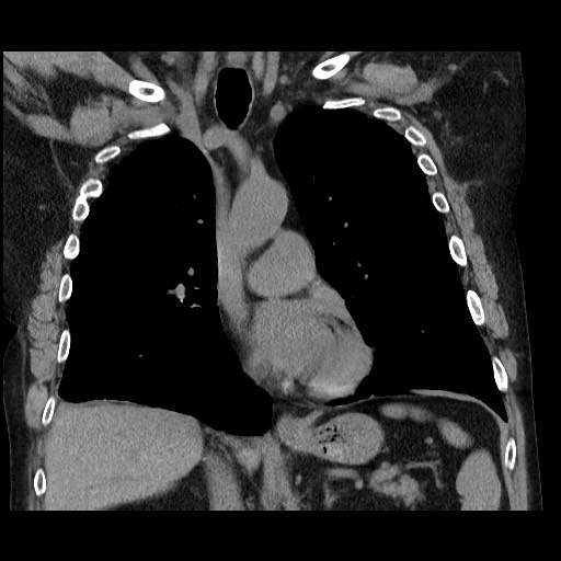 Bronchial stenosis - lung transplant (Radiopaedia 73133-83848 Coronal non-contrast 33).jpg