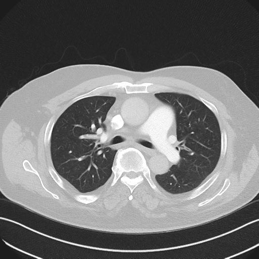 Bronchiectasis (Radiopaedia 39385-41666 Axial lung window 27).png