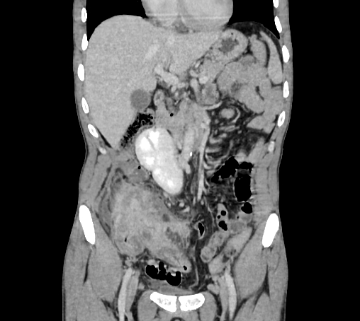 File:Bronchiectasis in Crohn disease (Radiopaedia 60311-67977 C 29).jpg