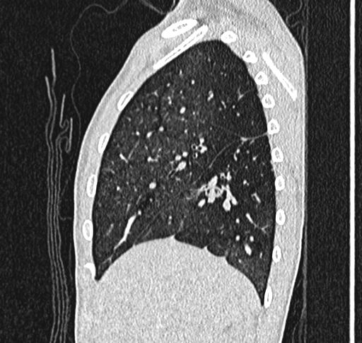 Bronchiolitis obliterans (Radiopaedia 71538-81897 Sagittal lung window 15).jpg