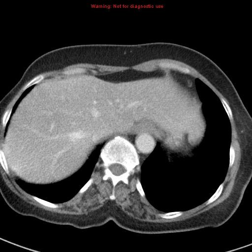 File:Bronchoalveolar carcinoma (BAC) (Radiopaedia 13436-13392 B 46).jpg