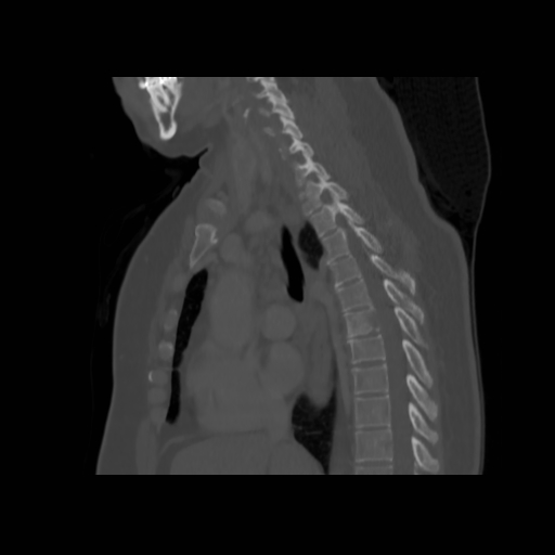 Bronchogenic carcinoma (Radiopaedia 73497-84262 Sagittal bone window 78).jpg