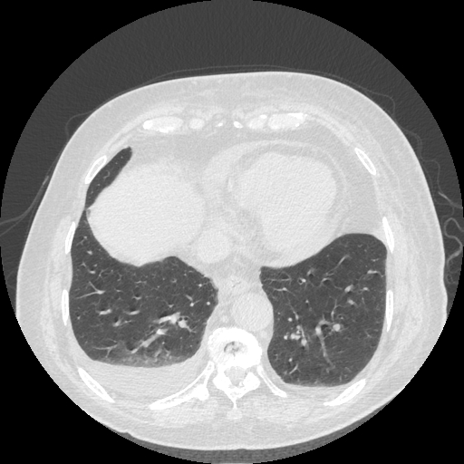 Bronchogenic carcinoma with metastatic lymphadenopathy (Radiopaedia 37671-39569 Axial lung window 42).jpg