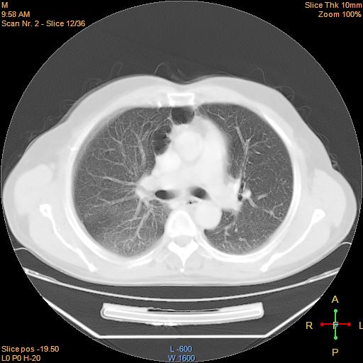 File:Bronchogenic carcinoma with superior vena caval invasion (Radiopaedia 22378-22406 lung window 9).jpg